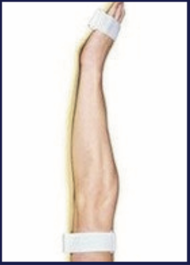 Emergency Splint Arm (Long) — Scanda Enterprises, medical supplies Moosapet Hyderabad